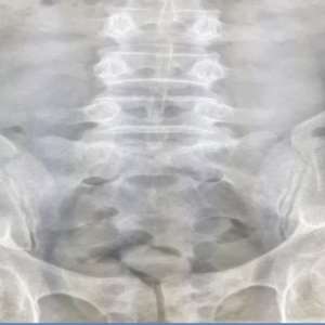 COCAINĂ TRANSPORTATĂ ÎN STOMAC