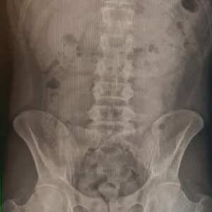 COCAINĂ TRANSPORTATĂ ÎN STOMAC